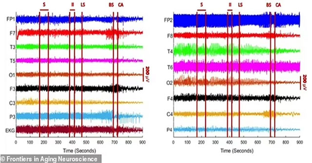 Lần đầu tiên ghi được sóng não của người chết, hé lộ sự thật khủng khiếp