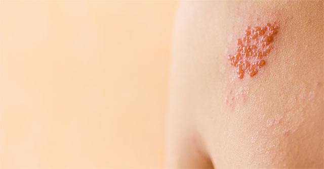 Bệnh zona thần kinh – Triệu chứng, nguyên nhân và cách điều trị